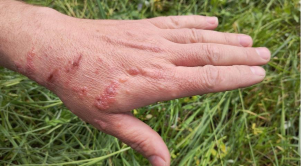 Борьба с борщевиком: эффективные методы и первая помощь